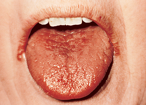 Dry Lips And Mouth 52
