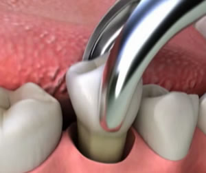 tooth-extraction