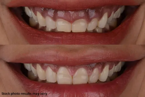 gum