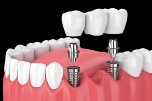 implant